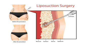 The Cost of Liposuction: What You Need to Budget for Your Body Transformation!